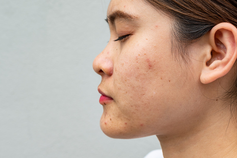 側面特寫的亞洲婦女的臉有各種各樣的問題在她的皮膚上(如痤瘡，丘疹，毛孔和黃褐斑等)。圖片素材