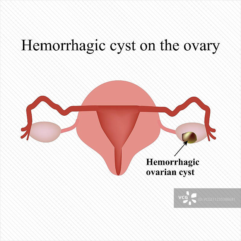 卵巢出血性囊肿卵巢信息图图片素材