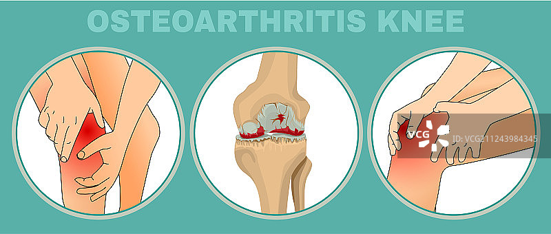 骨关节炎膝盖海报图片素材