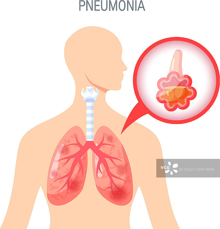 肺炎疾病图标在平面风格图片素材