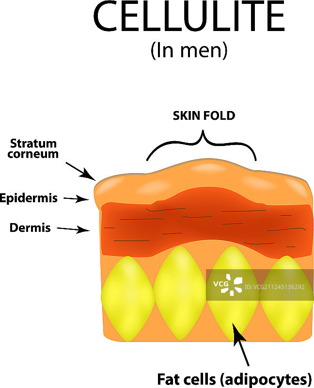男性蜂窝织炎皮肤老化信息图图片素材