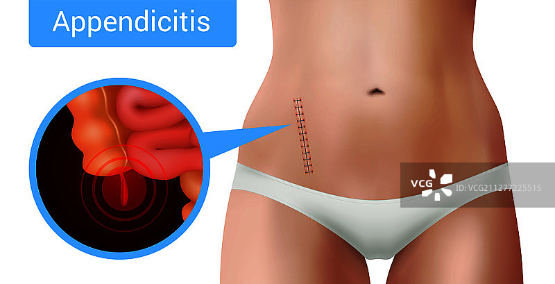 外科缝合线缝合逼真的阑尾炎组成与外科干预的标志上逼真的女性身体矢量插图图片素材