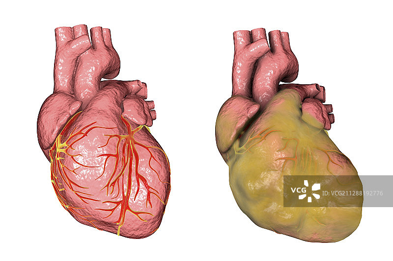 健康心脏和左心室肥厚心脏图片素材
