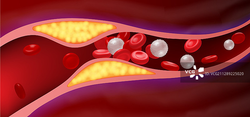 动脉脂肪阻塞导致血栓图片素材