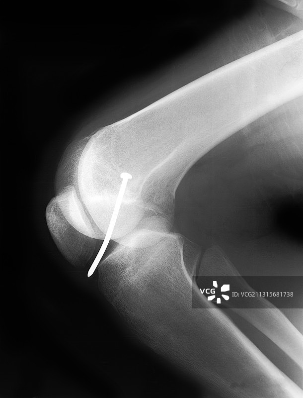 膝盖x射线图片素材