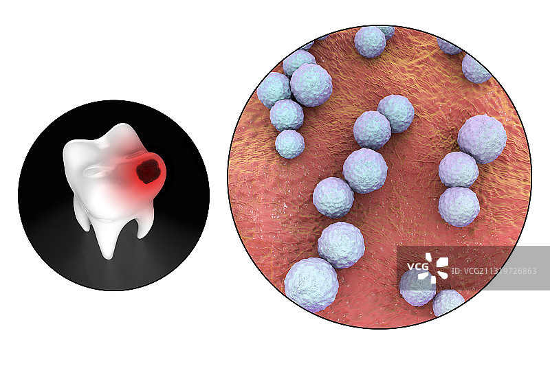 蛀牙和导致龋齿的细菌，艺术品图片素材
