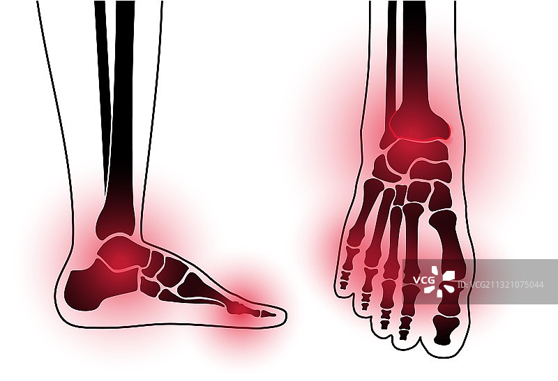 关节炎脚概念图片素材