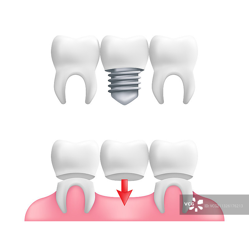 义齿概念-健康的牙齿与固定的牙齿图片素材