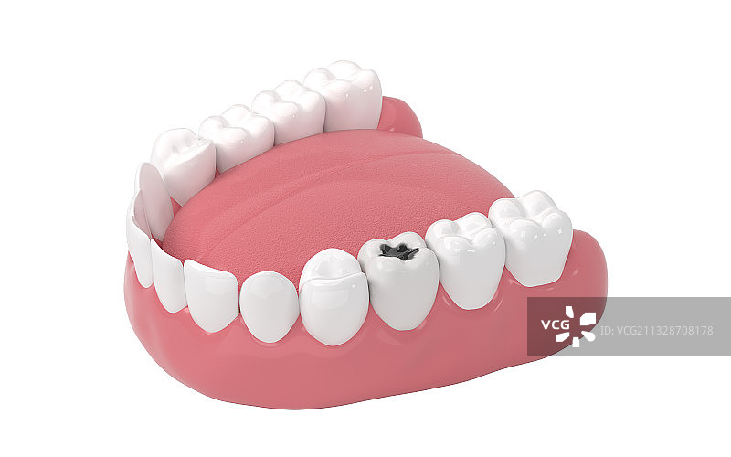 口腔里的蛀牙 3D渲染图片素材