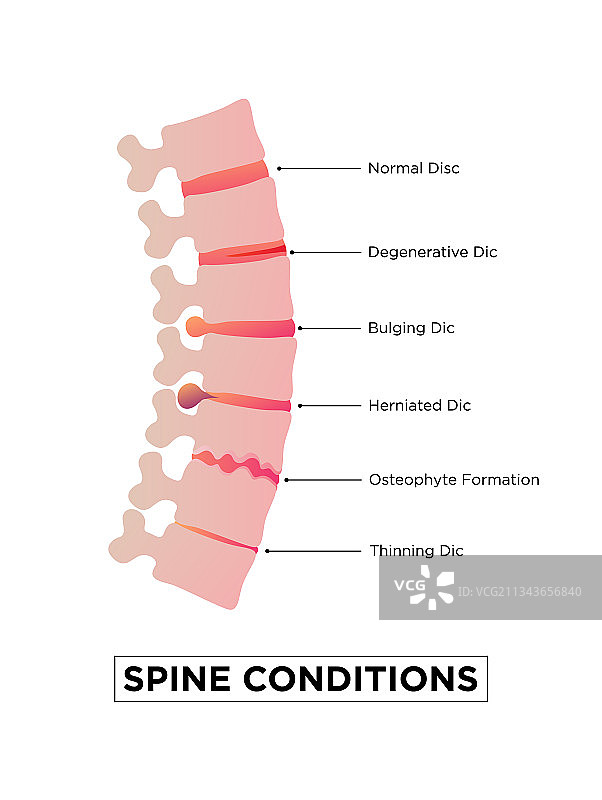 阶段脊髓骨软骨病图片素材