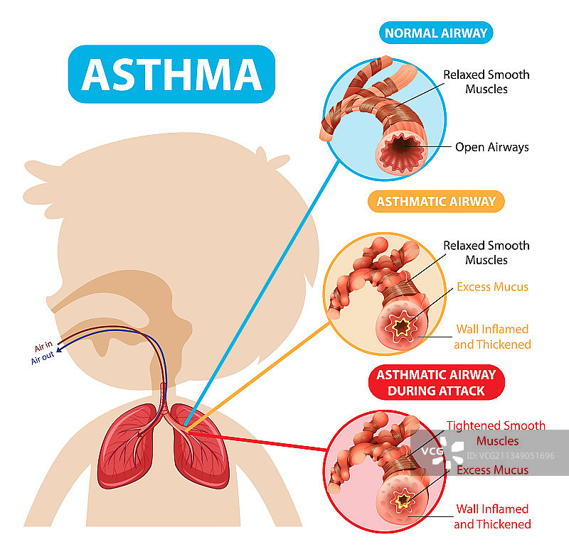 哮喘图包括正常气道和哮喘图片素材