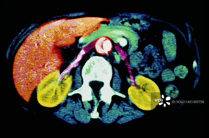 腹部健康肾脏彩色CT扫描图片素材
