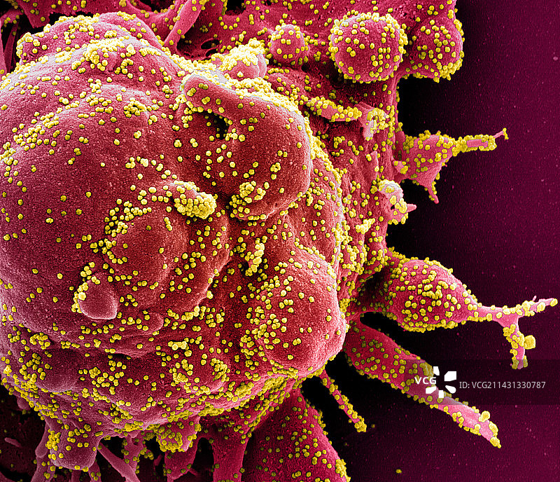 感染Covid-19冠状病毒颗粒的细胞，扫描电镜图片素材