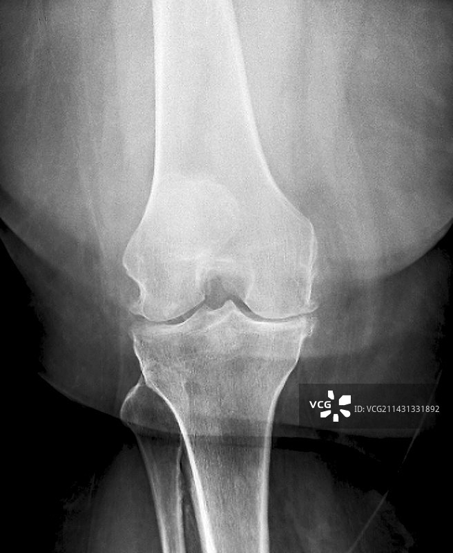 膝关节骨关节炎，x光检查图片素材