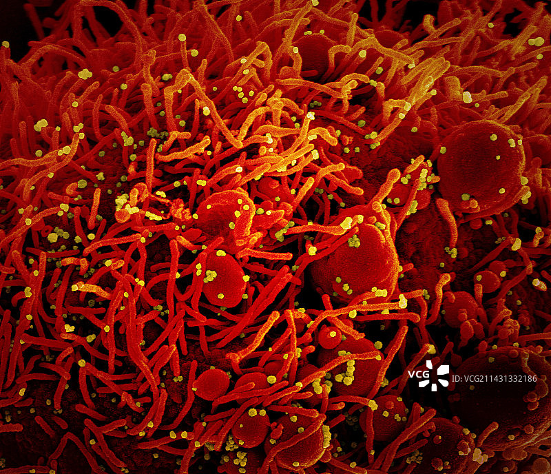 感染Covid-19冠状病毒颗粒的细胞，扫描电镜图片素材