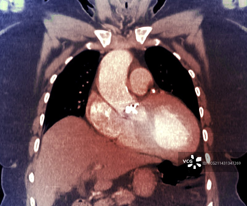 心脏瓣膜钙化，CT扫描图片素材