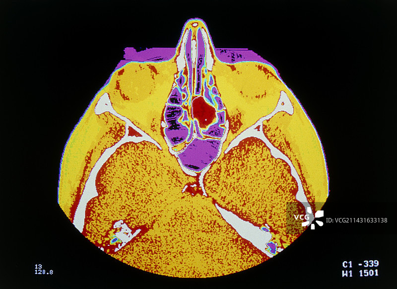 头部假彩色CT扫描显示鼻息肉图片素材