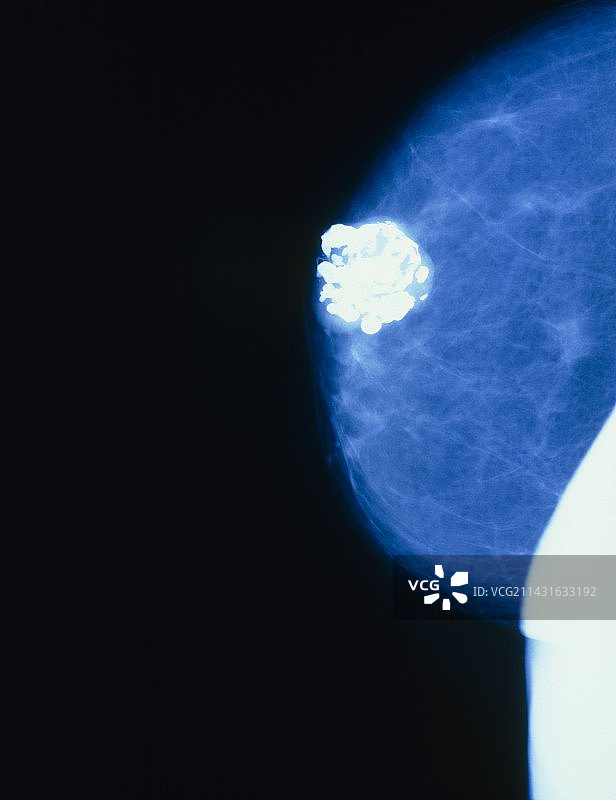 显示良性肿瘤的女性乳房x光照片图片素材