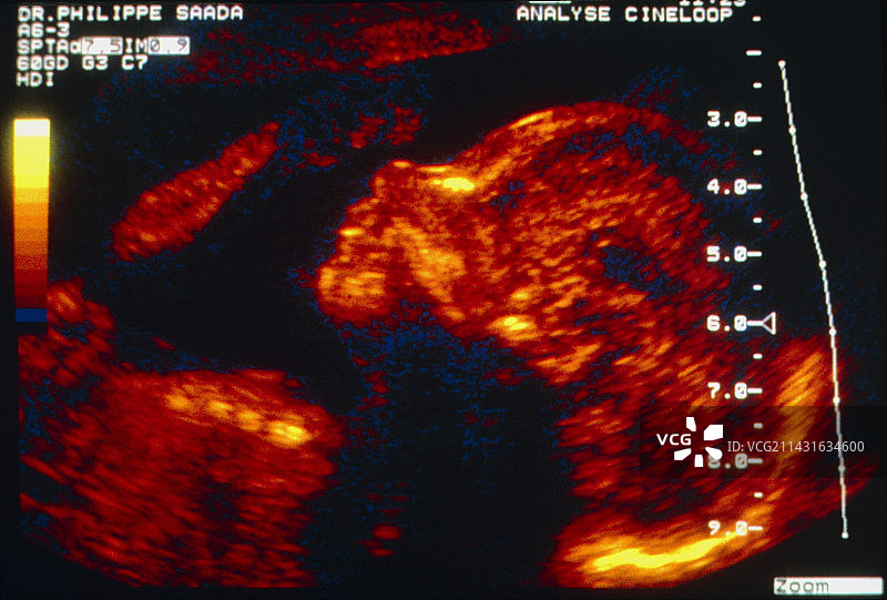 5个月大胎儿面部彩超图片素材