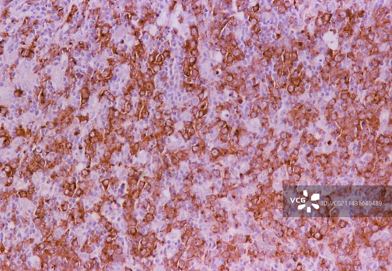 高度非霍奇金淋巴瘤的彩色LM图片素材