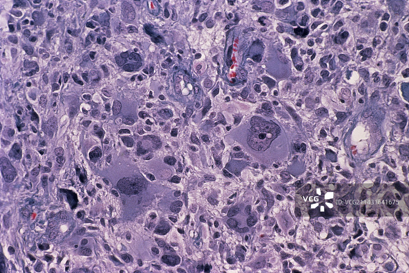 恶性胶质瘤脑瘤图片素材