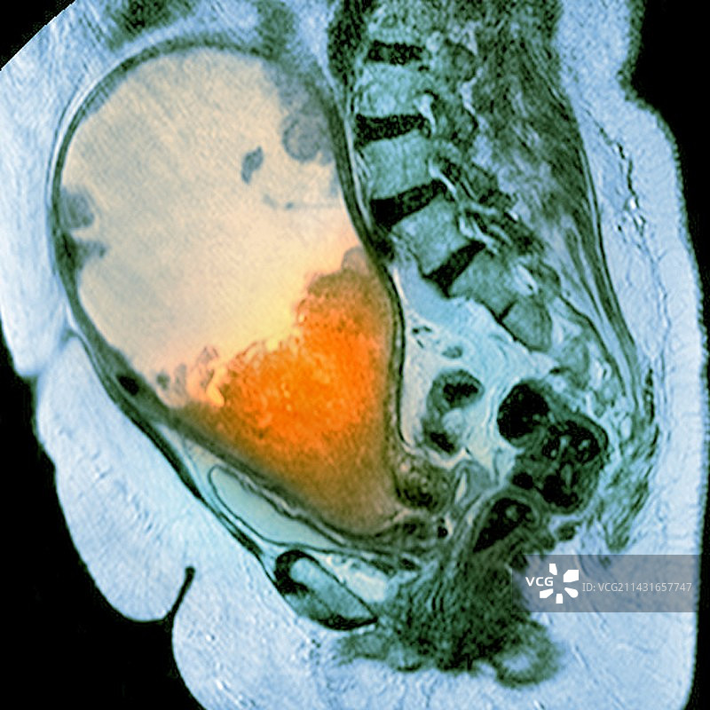 子宫癌，MRI扫描图片素材