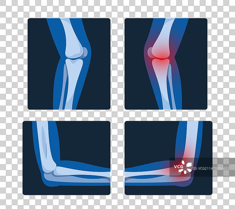 肘部和膝盖的x光片是诊断性的图片素材