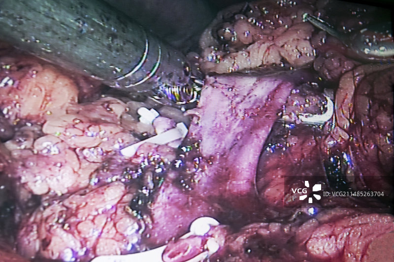 机器人肾脏摘除手术图片素材