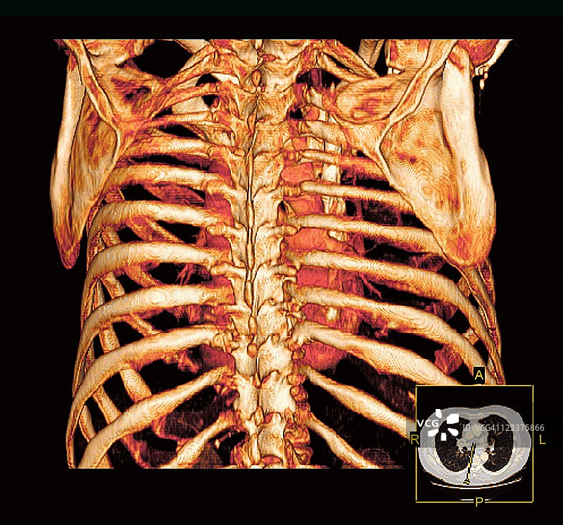 胸腔和心脏，3D CT扫描图片素材