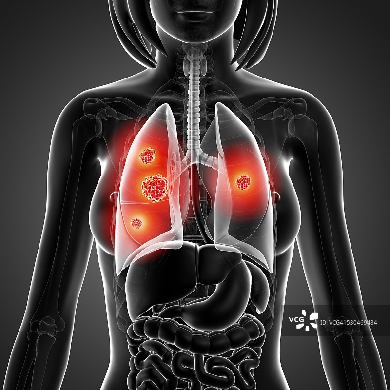 肺癌，电脑绘图。图片素材