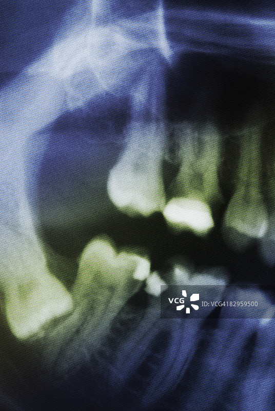 牙科x光的特写图片素材