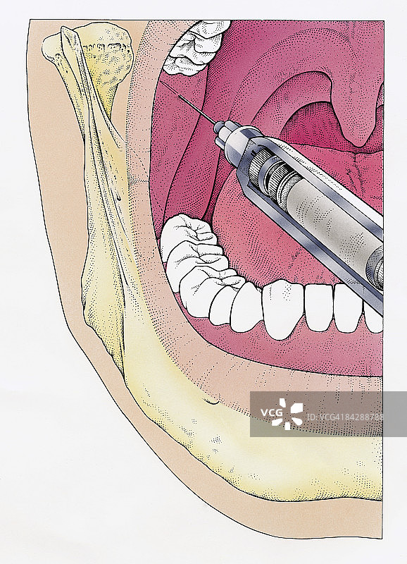 使用注射器注射张开的人的嘴，在显示颌骨，牙齿和会厌的横切面上看到的插图图片素材