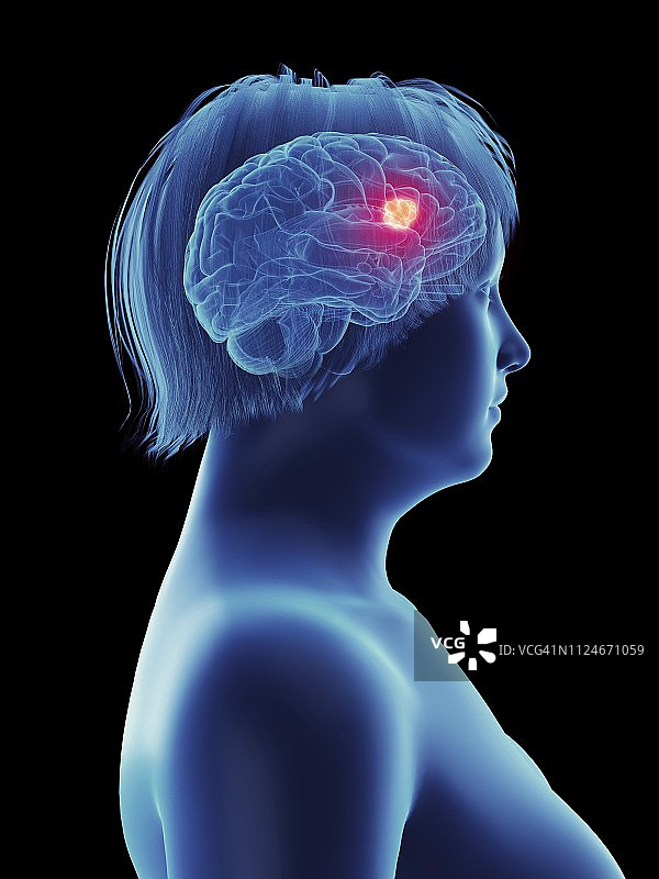 一个女人大脑里的肿瘤图片素材