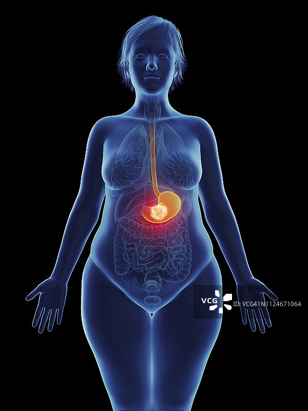 一个女人胃里的肿瘤图片素材