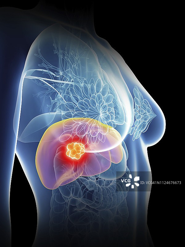 图示:一位女性肝癌患者图片素材