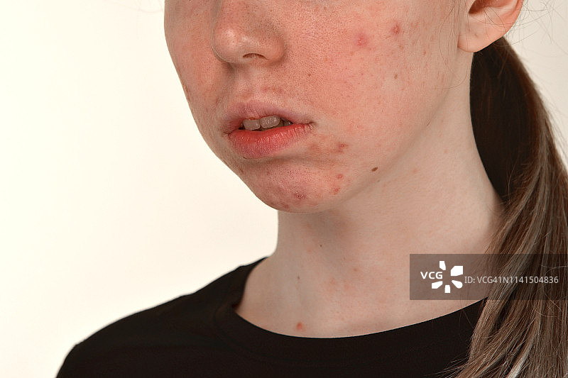 后痤疮，疤痕和红色溃烂的丘疹在一个年轻女子的脸上。皮肤问题和谐波故障的概念图片素材