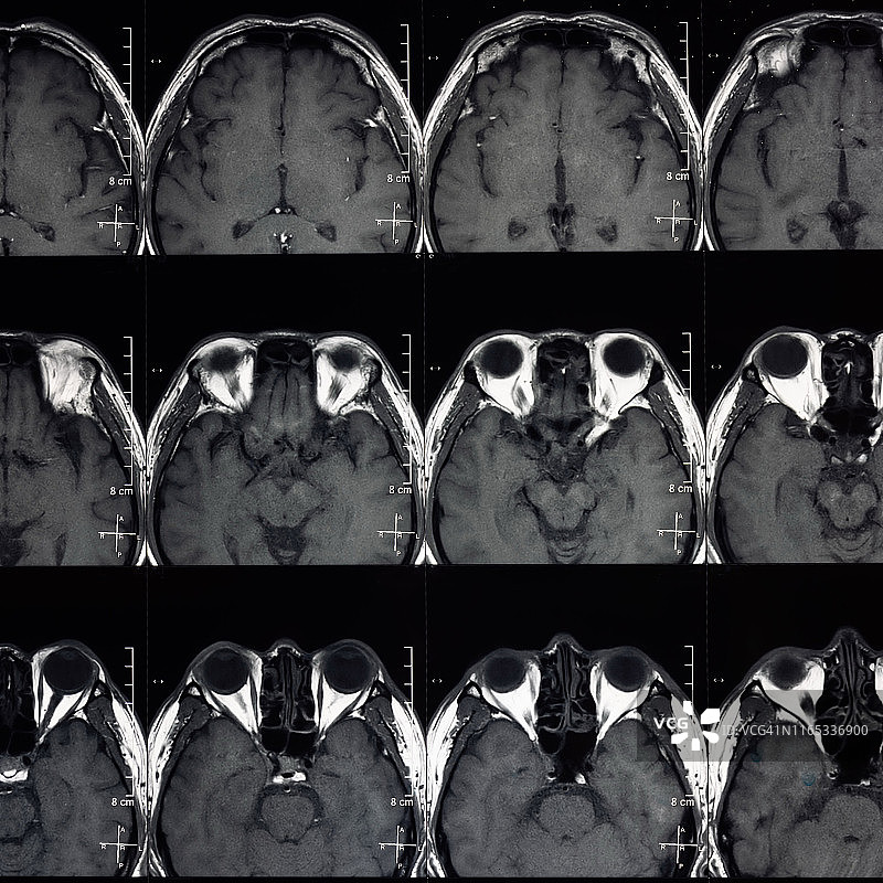 MRI扫描人类头部断层扫描图片素材