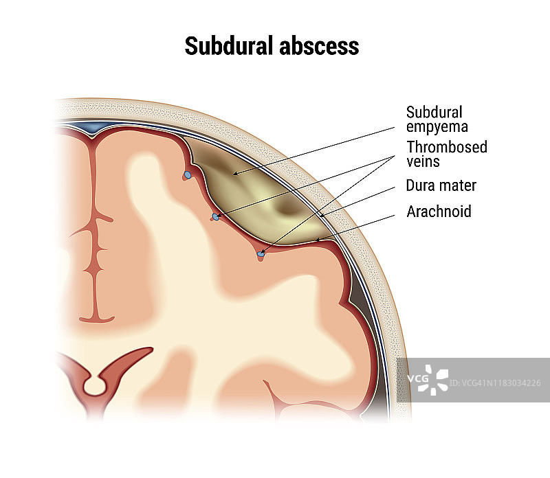 硬脑膜下脓肿向量图片素材