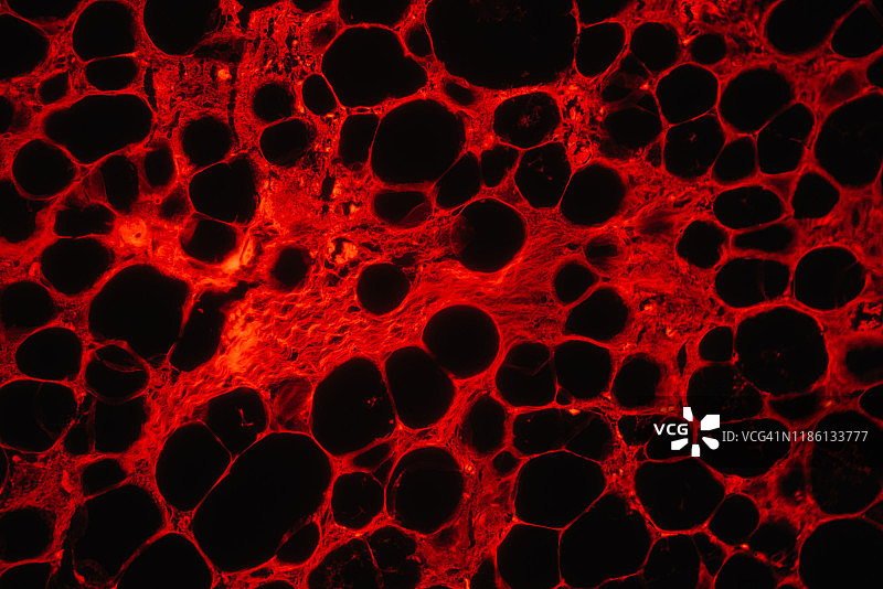 脂肪肉瘤的红色荧光显微图图片素材