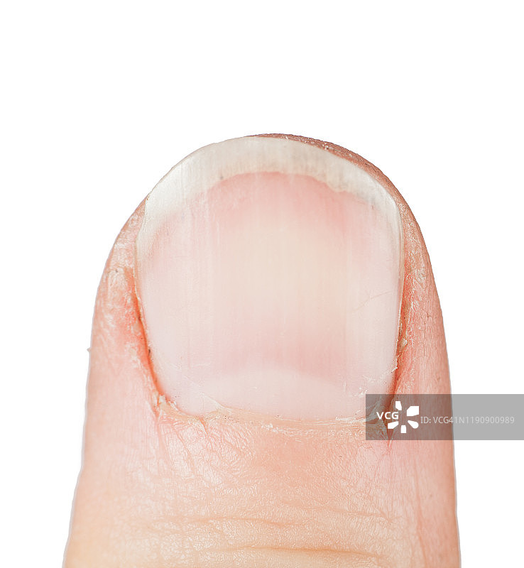 拇指损坏的手指闭合孤立在白色背景图片素材