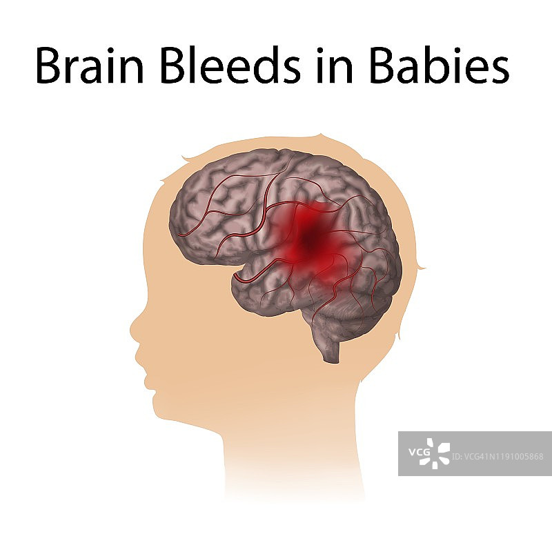 婴儿脑出血，插图图片素材