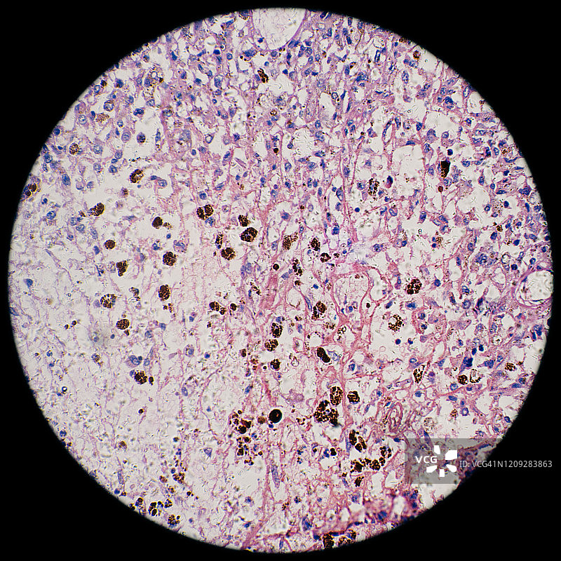 显微镜下观察人类黑色素瘤癌细胞图片素材