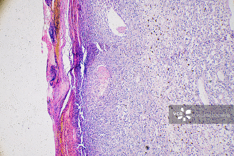 人类黑色素瘤癌细胞的显微照片图片素材