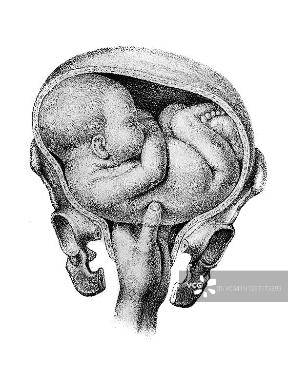 1841年，柏林，d·w·布希的旧书《阿特拉斯·阿比顿根》中，医生帮助婴儿出生图片素材