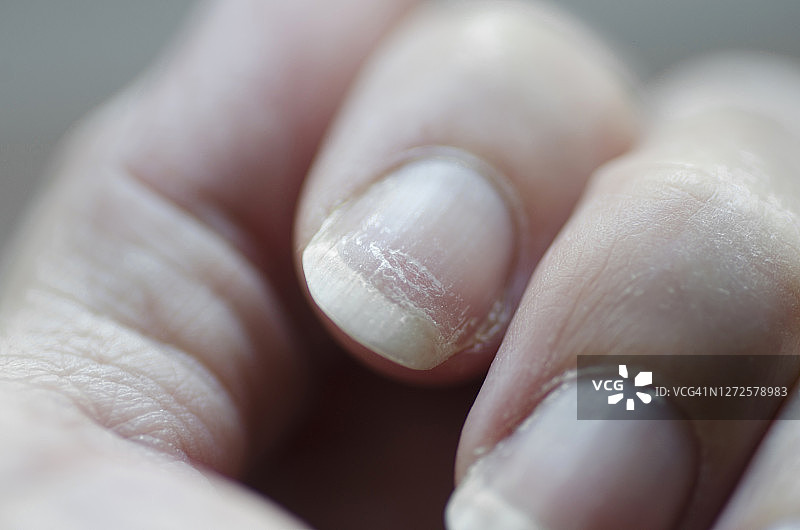 特写的脆性指甲。使用指甲油后对指甲的损害。指甲剥落。指甲的损伤。破碎的钉子。图片素材