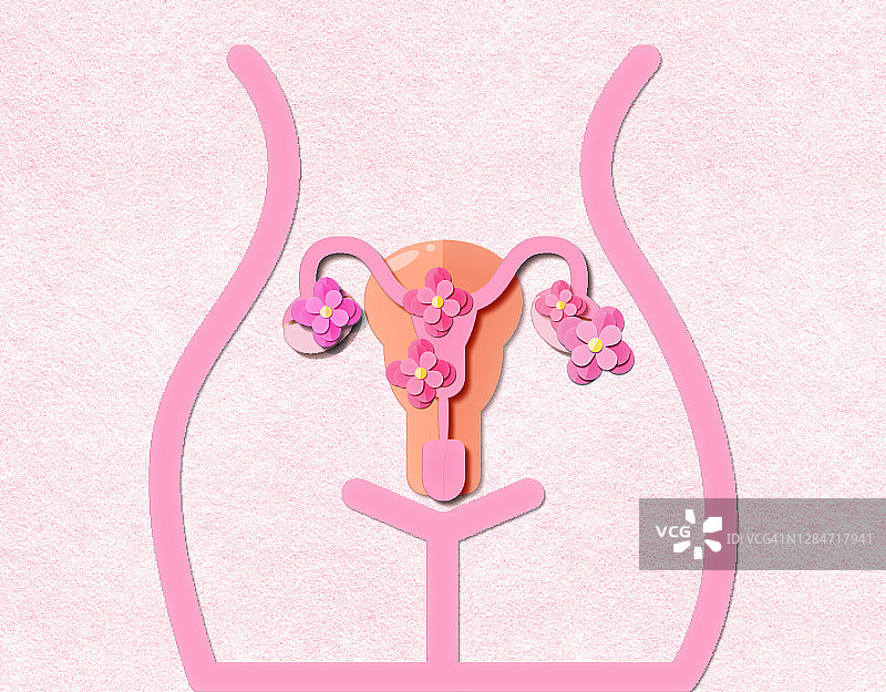 多囊卵巢综合征的概念在剪纸图片素材