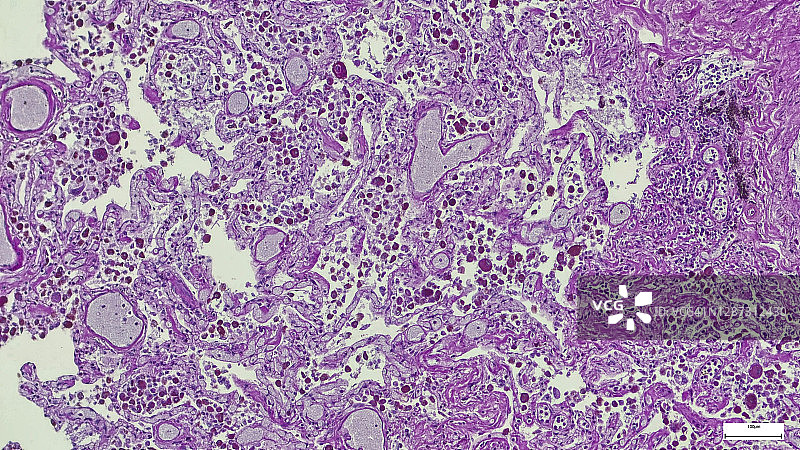 专业制作的乳腺导管癌切片的显微镜照片。图片素材