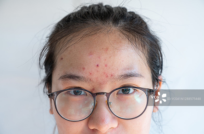 特写的亚洲妇女与丘疹和痤疮在她的额头上发炎。图片素材