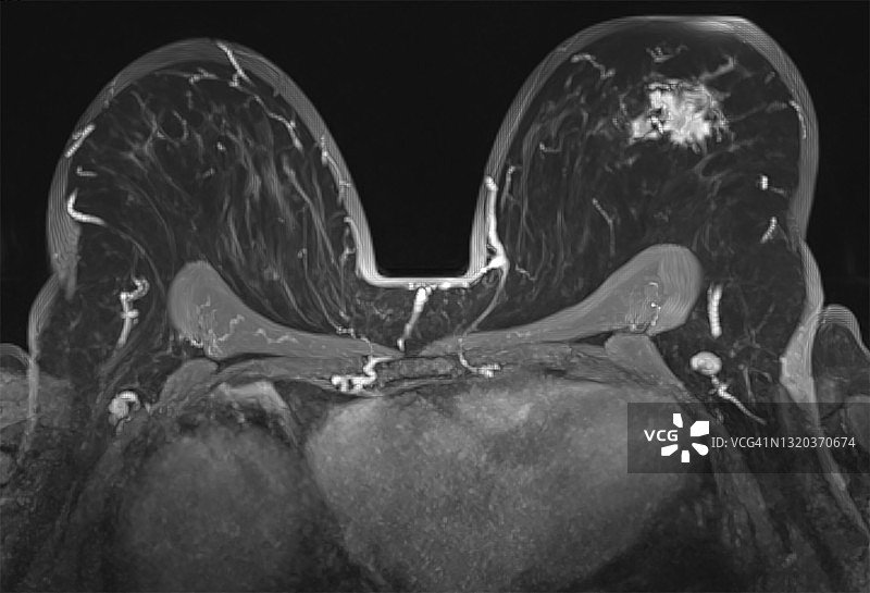 乳腺MRI显示左乳肿瘤病变，轴位视图图片素材