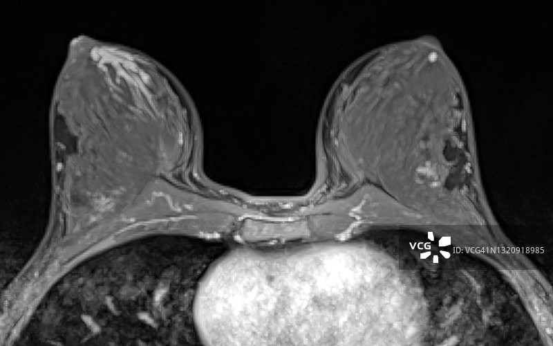 乳腺MRI，轴位T1示轻度乳腺导管扩张图片素材